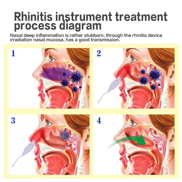 Appareil de thérapie laser basse fréquence pour le traitement de la sinusite, de la rhinite, de la fièvre des foins, du nez qui coule et des éternuements