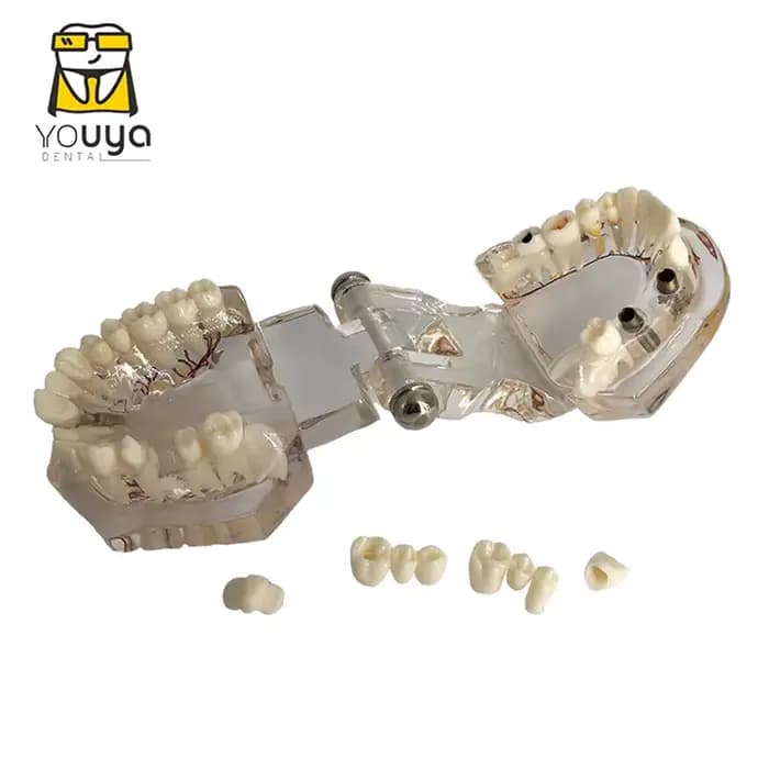 Réparation neurale des dents, modèle pathologique d'implant dentaire, dentiste, étudiants, Communication, apprentissage, recherche, enseignement des maladies buccales
